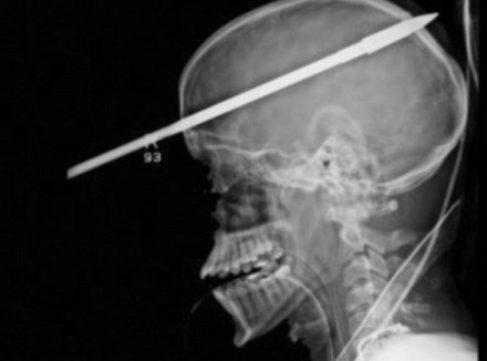 Miami_Teen_Survives_Being_Accidentally_Shot_in_Head_with_Spear_Gun_thumb.jpg